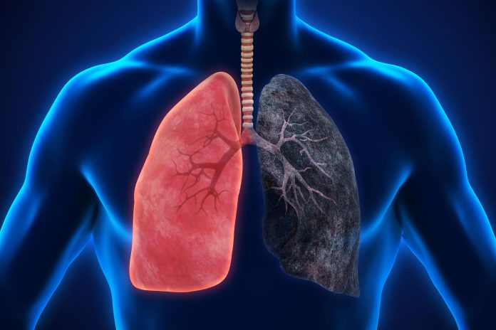 Γιατί η γήρανση των πνευμόνων μετατρέπει τις ήπιες λοιμώξεις σε απειλητική για τη ζωή ασθένεια Γιατί η γήρανση των πνευμόνων μετατρέπει τις ήπιες λοιμώξεις σε απειλητική για τη ζωή ασθένεια