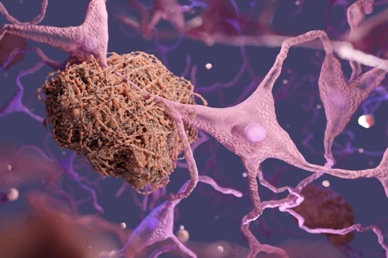 Επιστήμονες ανακαλύπτουν τρόπο για να αντιστρέψουν τη χημική διαδικασία που συνδέεται με τη νόσο του Αλτσχάιμερ