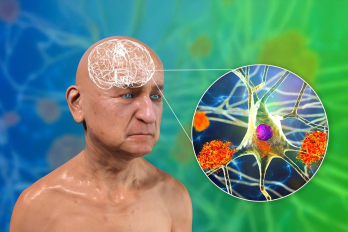 Νέα μελέτη αμφισβητεί δεκαετίες κατανόησης του Αλτσχάιμερ με την ανακάλυψη μικροσωληνίσκων Νέα μελέτη αμφισβητεί δεκαετίες κατανόησης του Αλτσχάιμερ με την ανακάλυψη μικροσωληνίσκων