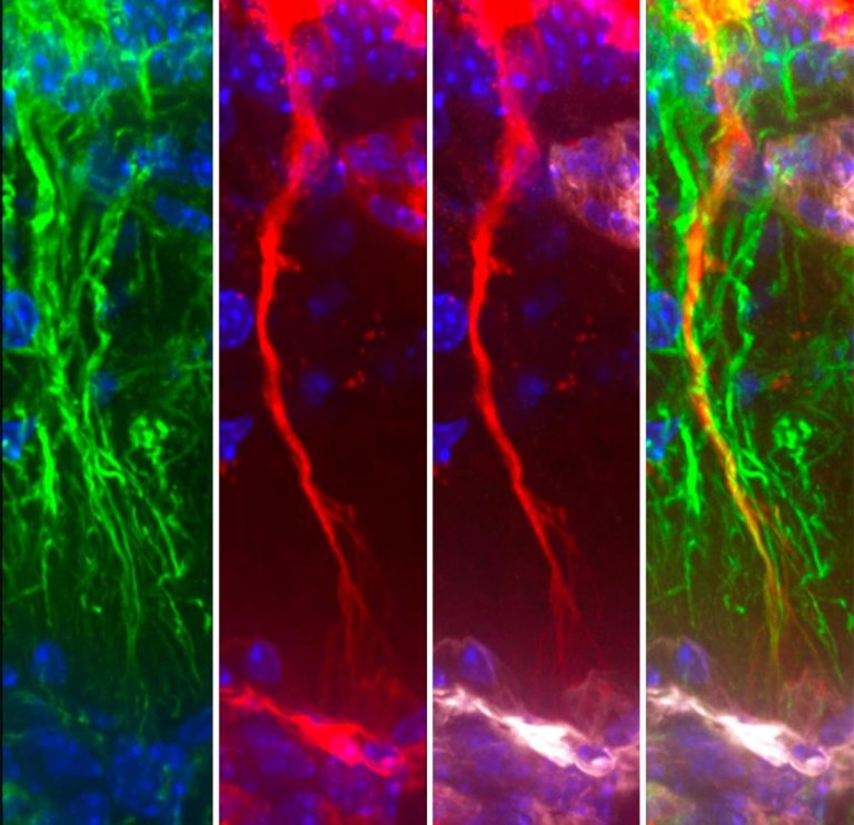 Επιστήμονες ανακάλυψαν κρυμμένα εγκεφαλικά κύτταρα που αφαιρούν την τοξική πρωτεΐνη του Αλτσχάιμερ