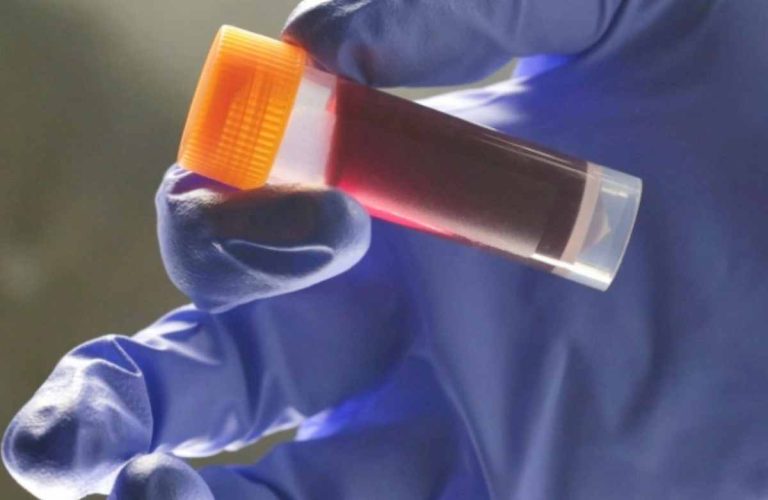 Μια ομάδα αίματος έχει μεγαλύτερο κίνδυνο για διαβήτη τύπου 2