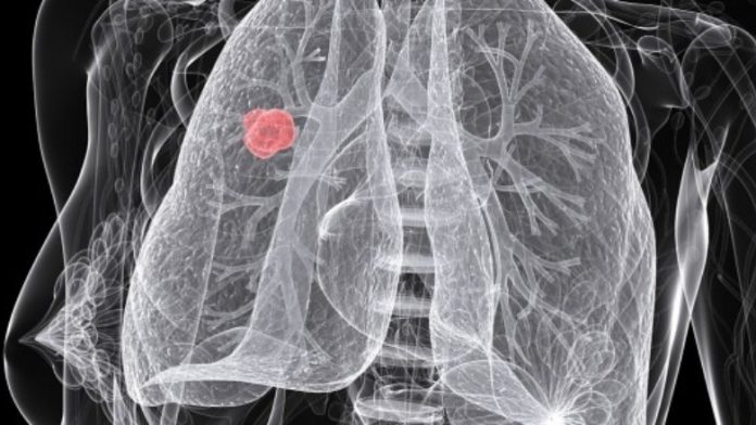 Καρκίνος του πνεύμονα σε μη καπνιστές: Μια αυξανόμενη πρόκληση Καρκίνος του πνεύμονα σε μη καπνιστές: Μια αυξανόμενη πρόκληση