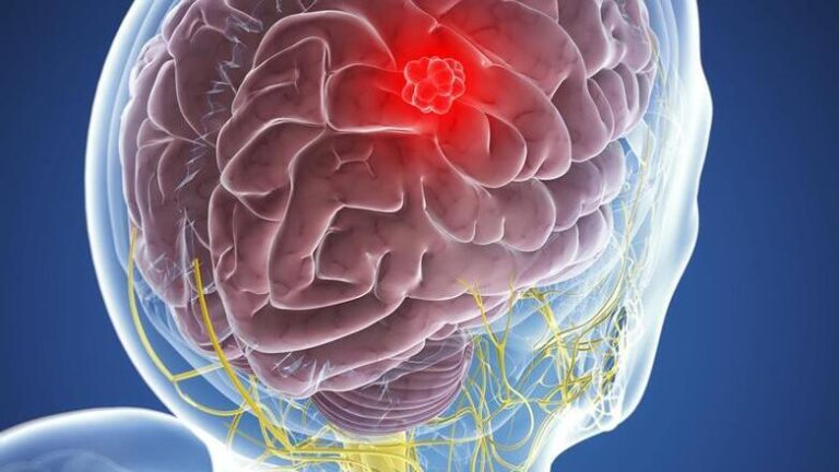 Η χρήση ψυχοδραστικών ουσιών συνδέεται με τον κίνδυνο εγκεφαλικού επεισοδίου ακόμα και σε νέους