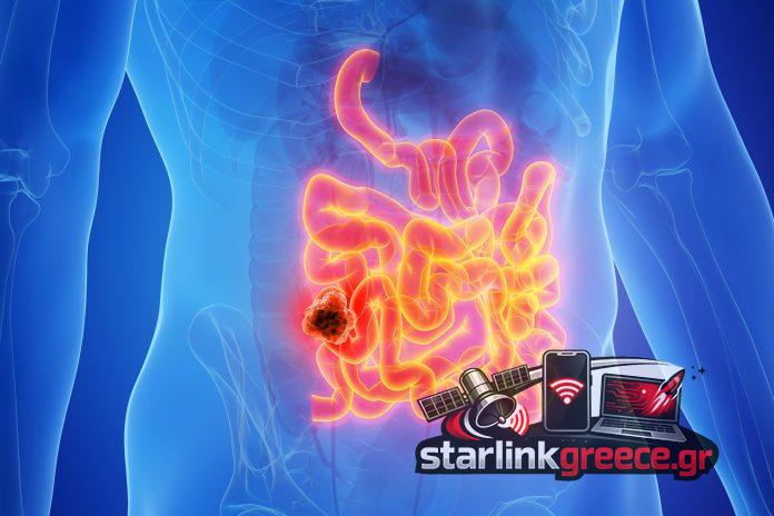 Επαναστατική θεραπεία καρκίνου εντέρου με 3 χρόνια ύφεσης Επαναστατική θεραπεία καρκίνου εντέρου με 3 χρόνια ύφεσης