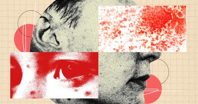 «Γιατί ο έρπης ζωστήρας είναι πιο ανησυχητικός απ’ ό,τι νομίζετε» «Γιατί ο έρπης ζωστήρας είναι πιο ανησυχητικός απ' ό,τι νομίζετε»