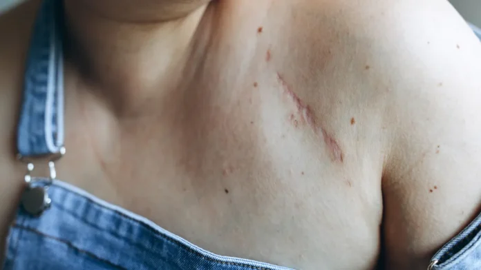 Γιατί τα σημάδια παραμένουν μόνιμα | Λαϊκή Επιστήμη Γιατί τα σημάδια παραμένουν μόνιμα | Λαϊκή Επιστήμη